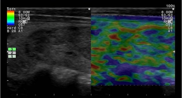 УЛЬТРАЗВУКОВАЯ ЭЛАСТОГРАФИЯ В ОЦЕНКЕ ПАТОЛОГИИ ЩИТОВИДНОЙ ЖЕЛЕЗЫ - Статьи RH