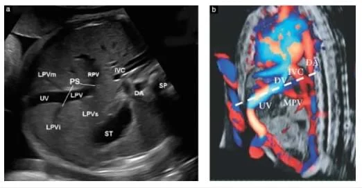 Внутриутробное развитие умбиликально-портальной венозной системы: двух- и трехмерное ультразвуковое исследование - Статьи RH