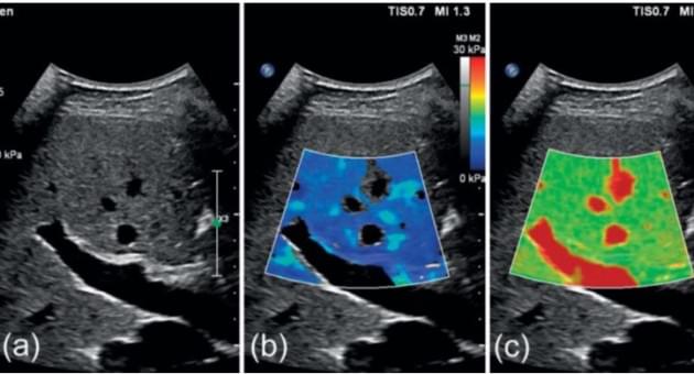 Керівництво та рекомендації  EFSUMB по клінічному використання ультразвукової еластографії печінки - Статті RH