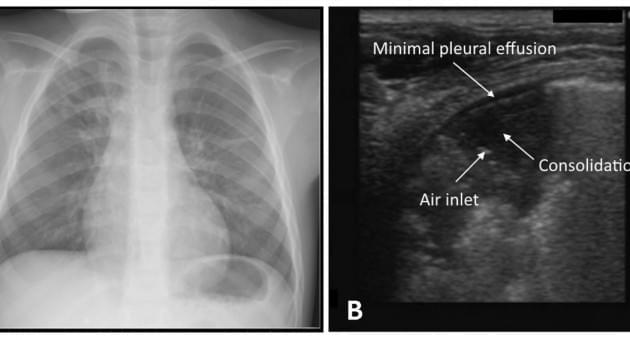 Ультразвуковое исследование легких может быть безопасной альтернативой рентгенографии грудной клетки при диагностике пневмонии у детей - Статьи RH