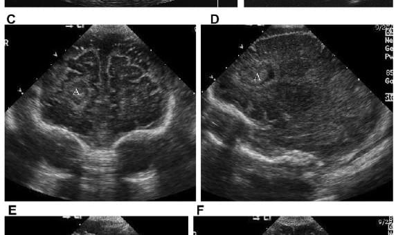 Нейросонография: Инфекционные заболевания, опухоли и другие повреждения - Статьи RH