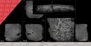 QView Medical демонструє QVCAD для обстежень ABUS на RSNA 2018 - Новини RH