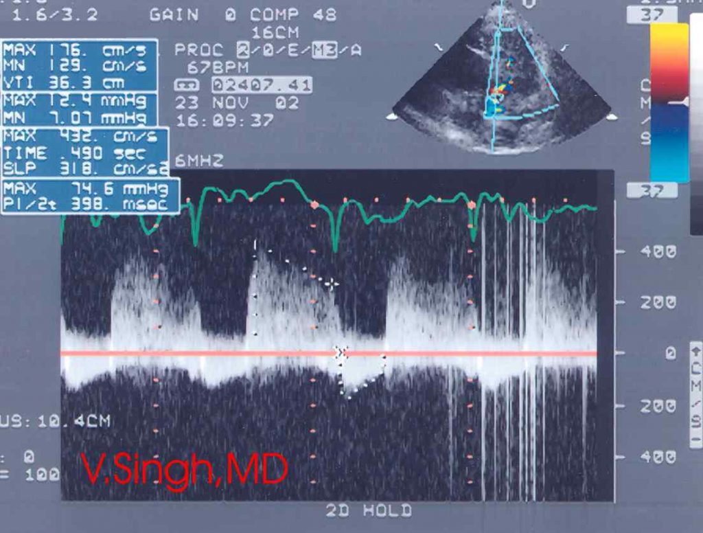 Ультразвуковая визуализация аортальной регургитации - Рисунок3