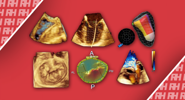 Обзор технологических достижений в ультразвуковой визуализации сердца - Статьи RH