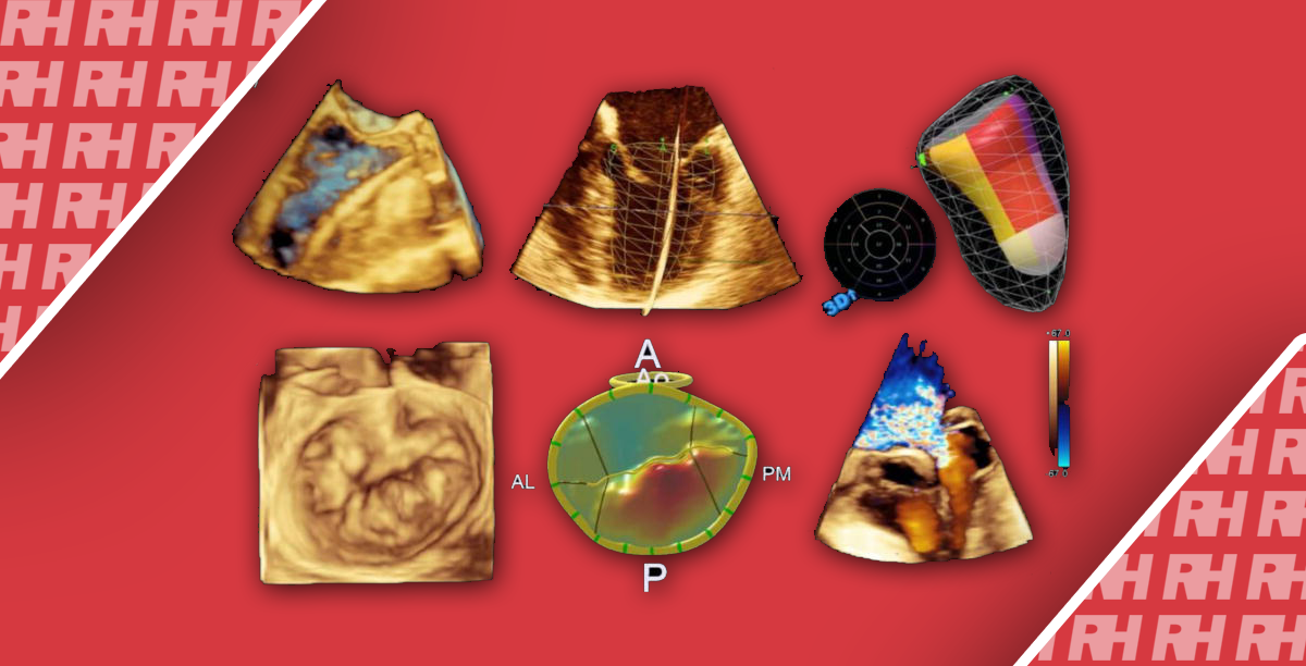 Обзор технологических достижений в ультразвуковой визуализации сердца - Статьи RH