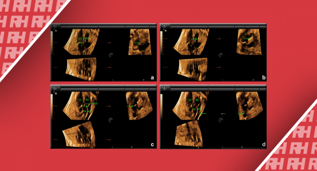 Переваги режиму 4D в візуалізації серця плоду - Статті RH