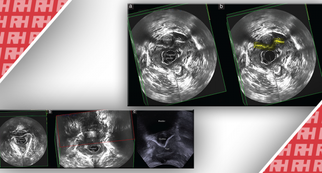 Связь между результатами 3D-эндовагинального и 2D-перинеального УЗИ тазового дна и симптомами у женщин с осложнениями среднего уретрального слинга - Статьи RH