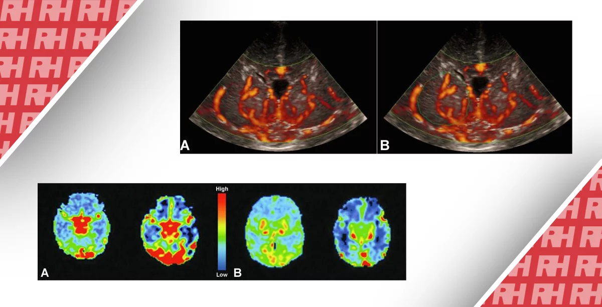 Візуалізація перфузії головного мозку у новонароджених. Частина перша - Статті RH