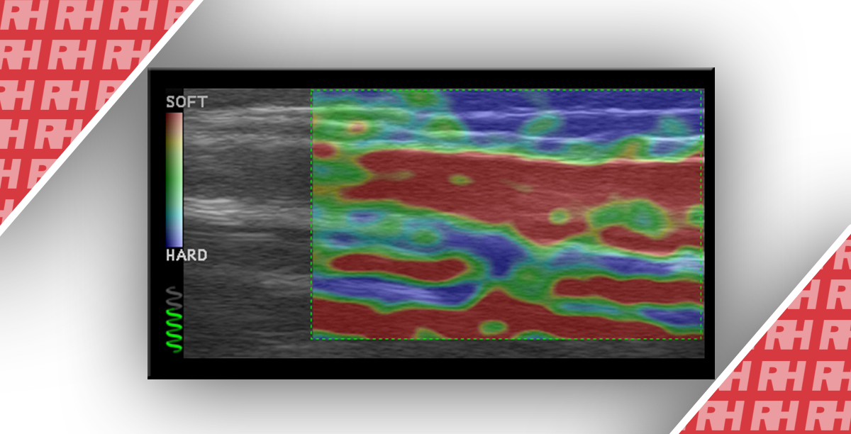 Использование ультразвуковой эластографии для определения возраста венозных тромбов. Оценка развития тромба у пациентов после склеротерапии - Статьи RH