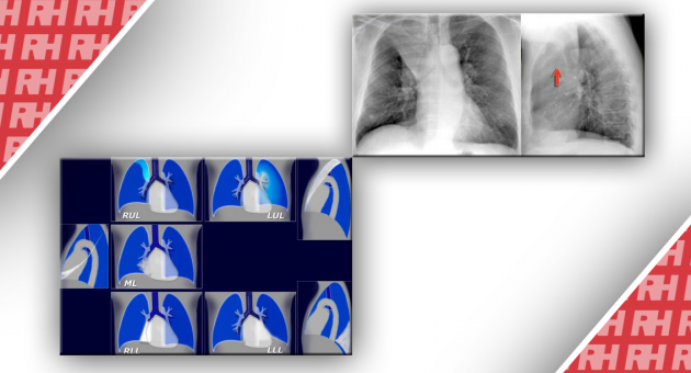 Рентгенологічна оцінка легень: норма та патологія. Частина 2 - Статті RH
