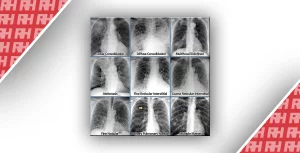 Рентгенологічна оцінка легень: норма та патологія. Частина 1 - Новини RH
