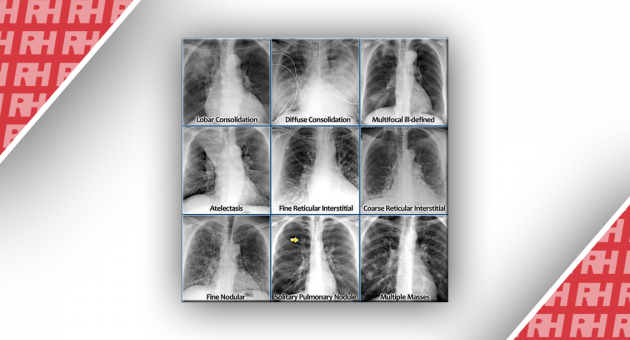 Рентгенологічна оцінка легень: норма та патологія. Частина 1 - Статті RH