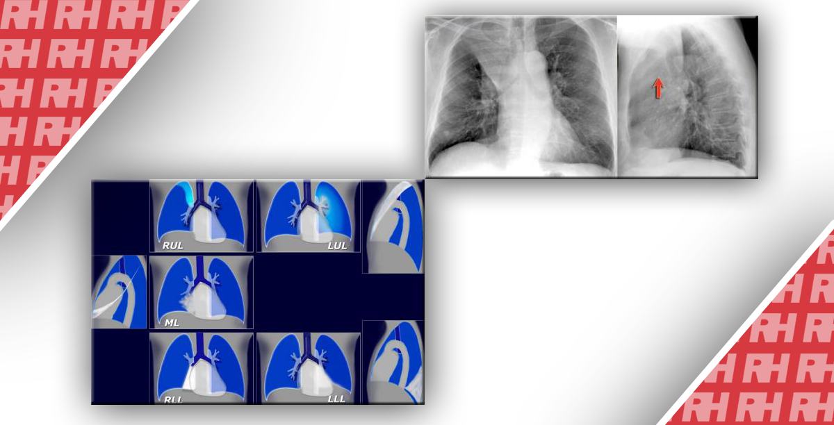 Рентгенологічна оцінка легень: норма та патологія. Частина 2 - Статті RH