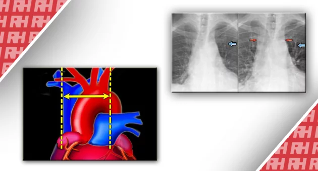 Рентгенологічна оцінка при серцевій недостатності - Статті RH