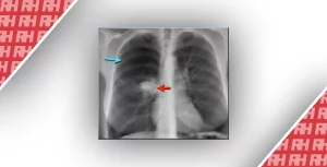 Рентгенологічна оцінка легень: норма та патологія. Частина 3 - Новини RH