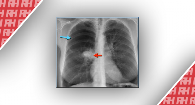 Рентгенологічна оцінка легень: норма та патологія. Частина 3 - Статті RH