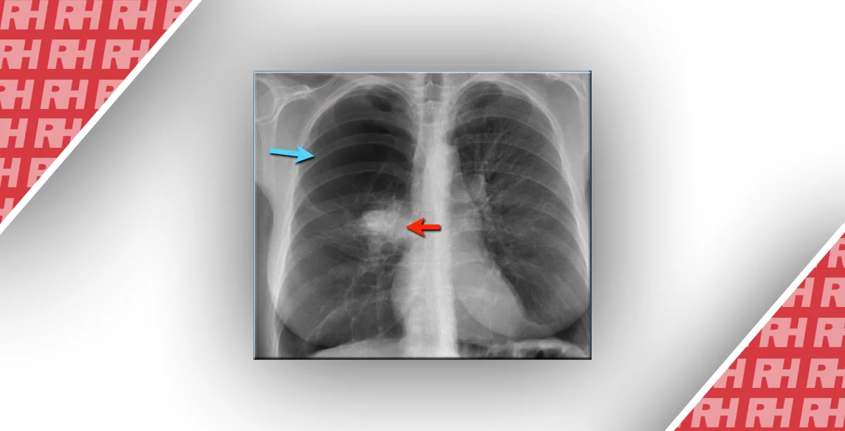 Рентгенологічна оцінка легень: норма та патологія. Частина 3 - Статті RH