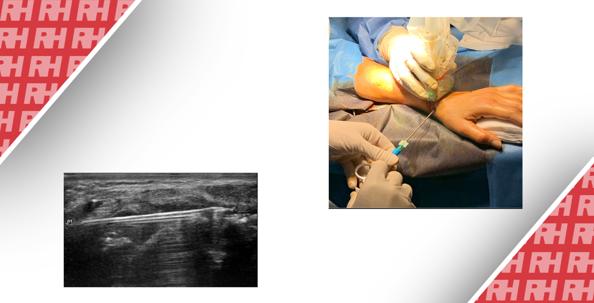Шлях доступу через анатомічну табакерку при ультразвуковій синовіальній біопсії зап’ястя дозволяє безпечно та ефективно проводити забір зразків тканин при запальних артритах - Статті RH