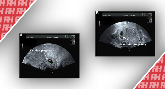 Лікування гетеротопічної цервікальної вагітності за допомогою ультразвукової гістероскопії: Звіт про випадок та огляд літератури - Статті RH