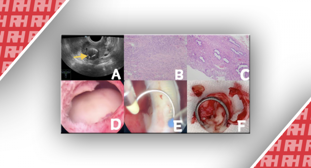 Гистероскопическое удаление подслизистой лейомиомы матки, полностью обернутой внутриматочной спиралью: Отчет о случае - Статьи RH