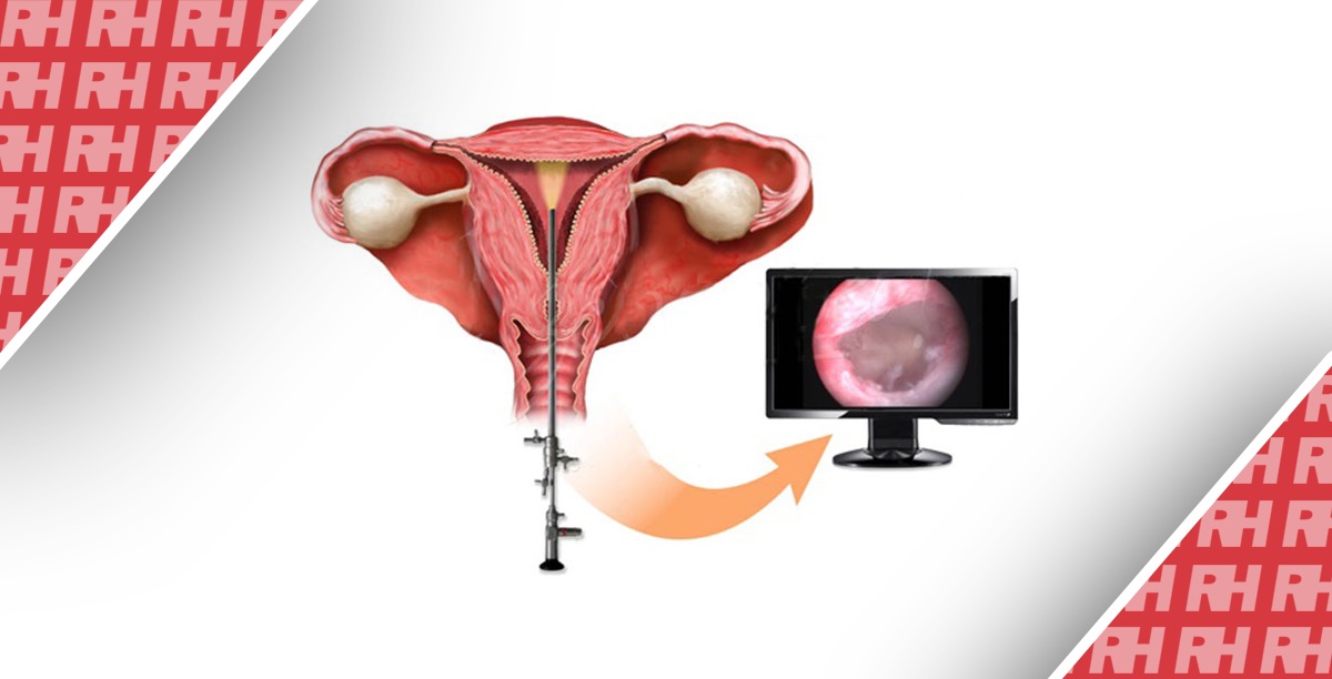 Гистероскопия при бесплодии у молодых женщин – наш опыт - Статьи RH