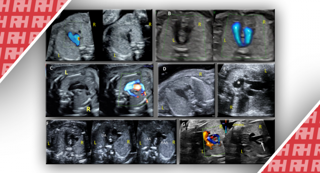 Настанови та Рекомендації щодо виконання ехокардіограми плода: Оновлення від Американського товариства ехокардіографії - Статті RH