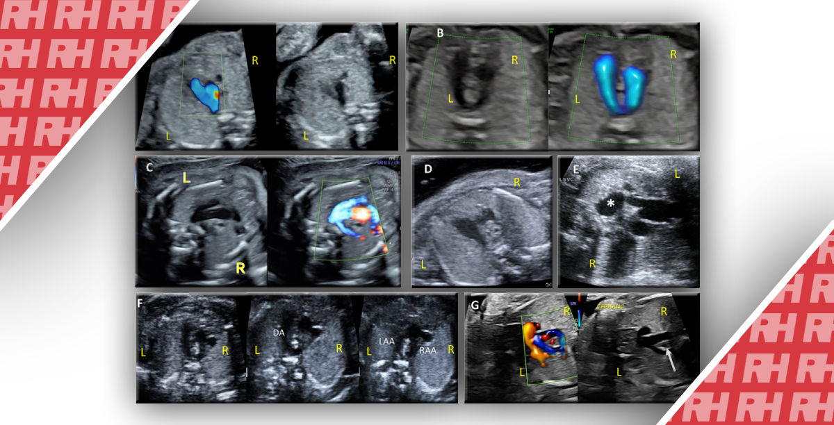 Настанови та Рекомендації щодо виконання ехокардіограми плода: Оновлення від Американського товариства ехокардіографії - Статті RH