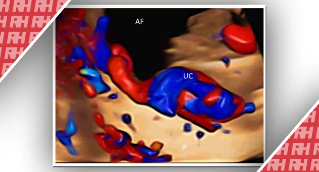 Оновлення щодо кольорової доплерографії акушерстві - Статті RH