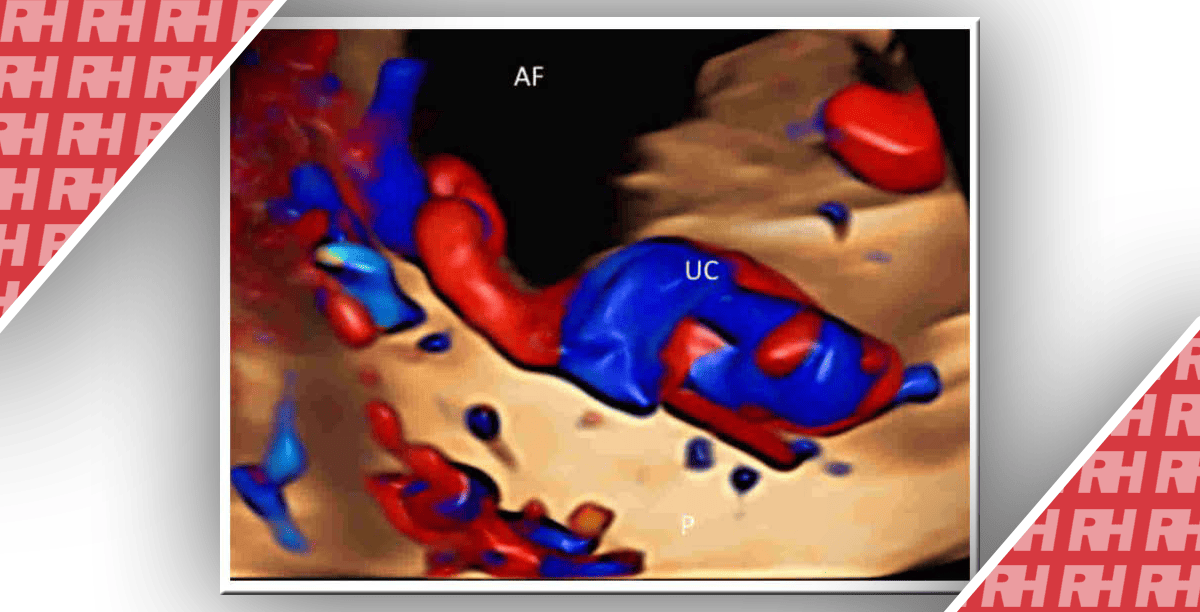 Обновление по цветной допплерографии в акушерстве - Статьи RH